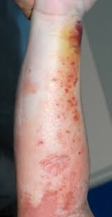 Sepsis and septic shock can result from an infection anywhere in the body, such as pneumonia, influenza, or urinary tract infections. Indiana University Infectious Diseases Fellowship On Twitter Idboardreview 25 F Flu Like Sx R Arm Pain Facial Throat Swelling Sepsis Vent Next Day Develops A Rash On R Arm Non Blanching Erythema Rapidly Progresses