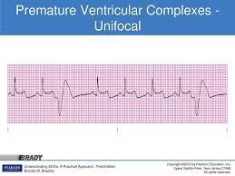 Your heart has 4 chambers: 10 Introducing The Ventricular Rhythms Ppt Download