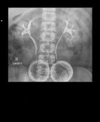 Image result for Intravenous Pyelogram