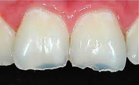 Treating Tooth Surface Loss Apollo Dental Southend