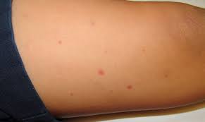 The bruises are not the result of bleeding disorders, a lack of vitamins or minerals, or a sign of a. Red Rash In A Young Boy With Difficulty Walking