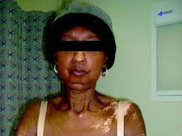 Cutaneous Findings of Collagen Vascular Disease and Related Emergent  Complications