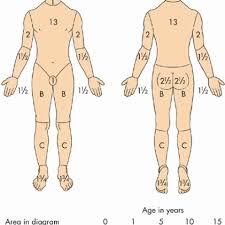 chart for calculation of percentage of bsa burn in children