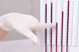 En temps normal, la vitesse de sédimentation est inférieure à 15 mm au cours de la première heure chez l'homme, et inférieure à 20 mm chez la femme. Femme Medecin Fait Des Erythrocytes Test De Vitesse De Sedimentation Dans Le Laboratoire Banque D Images Et Photos Libres De Droits Image 14122041
