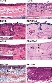 Unilateral polyps warrant biopsy and histological examination. Nasal Vestibule An Overview Sciencedirect Topics