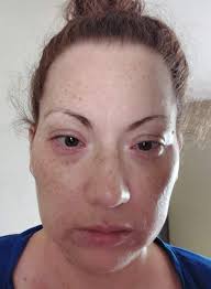 I don't have retinitis pigmotosa but my son does. I have retinol dystrophy  macular degeneration in both eyes my vision is so bad now camp tell is  curbed is there or flat