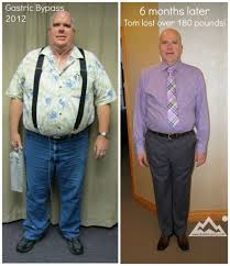 Pin On Wls Patient Stories