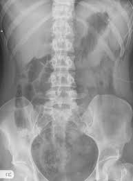 Vuj Calculus Radiology Case Radiopaedia Org Nephrolithiasis Calculus Radiology