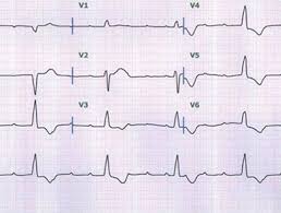 중년 이후의 남성에서 많이 볼 수 있고, 가장 전형적인 것은 빨리 걸을 때, 계단을 오를 때, 운동, 무거운 것을 들 때 등이 유인(誘因)이. ì•„ì´ì‹¬ìž¥