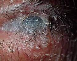 Management Of Acute Stevens Johnson Syndrome American Academy Of Ophthalmology