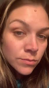 Aldi green cream for rosacea skin