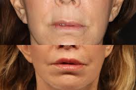 Ennis Plastic Surgery in Boca Raton