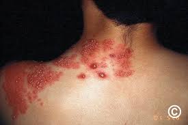 Image result for herpes zoster