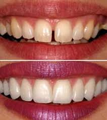 Dental veneers are a cosmetic dental restoration that consists of a thin shell of material that fits over your teeth. Dental Veneers Aldie Va Healthy Smile Stone Ridge Va