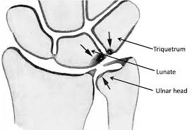 Ulnar Impaction Syndrome: A Case Series Investigating The Appropriate  Diagnosis, Management, And Post-Operative Considerations. - Abstract -  Europe Pmc