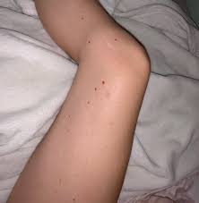 Image result for flea bites