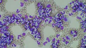 慢性骨髄性白血病 （まんせいこつずいせいはっけつびょう chronic myelogenous leukemia,cml）とは、 造血幹細胞 の遺伝子が後天的に変異して、造血細胞が分化・成熟能を保ったまま自律的な増殖をし、血液において白血球や時に血小板が増加する血液腫瘍である。 æ…¢æ€§éª¨é«„æ€§ç™½è¡€ç—… Konomiå‹•ç‰©ç—…é™¢ ç—‡ä¾‹ åºƒå³¶å¸‚