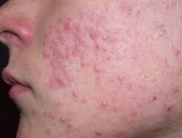 Isotretinoin may also be used for purposes not listed in this medication guide. Acne Vulgaris Dermnet Nz