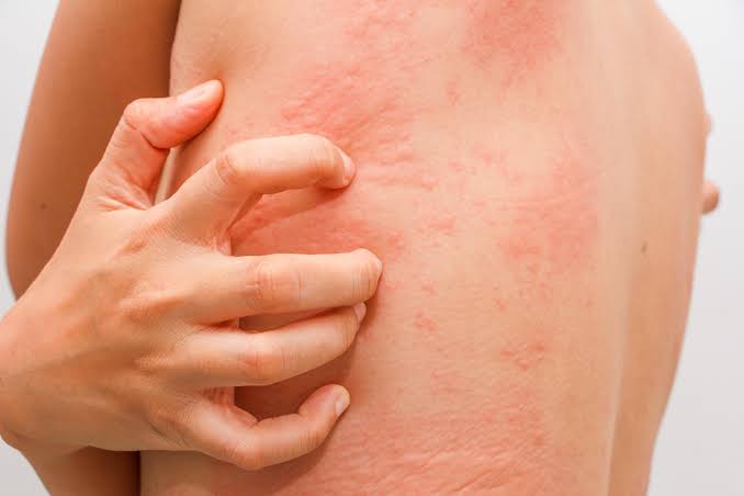 Q&A: Lý do nổi mẩn, ngứa khó chịu sau mỗi lần thể dục, ăn cay nóng