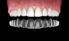Best reviews, without insurance ok. Invisalign Cost Omega Dental Houston Tx