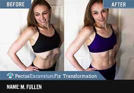 The best way i can explain it is feels like when your pg and the. 10 Proven Ways To Fix Flared Ribs Without Surgery In 2020 More