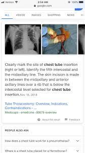 Pin By June Becker On Chest Tubes Chest Tube Video Image Chest