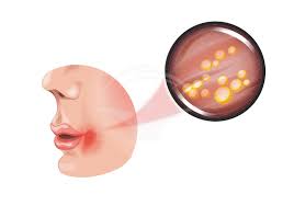 4 simptome pentru infecţia cu stafilococ auriu. Infectia Cu Stafilococ Simptome Investigatii Tratament