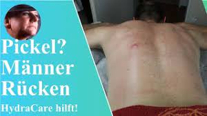 Pickel Jucken Manner Rucken Pickel Ruecken Manner Rucken Youtube
