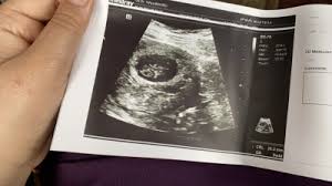 Bulantı kusma olmaması veya az olması. Ramzi Teorisi Saglik Diyet Spor