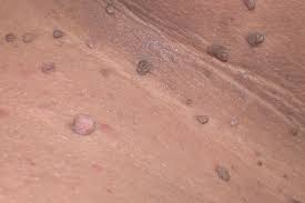 Image result for Skin Tag