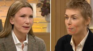 Så mycket bättre–stjärnan förklarar olyckliga skadan i Nyhetsmorgon "Fick  en smäll"