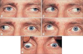 Image result for Pupillary Paralysis