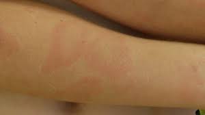 Lyme-Borreliose - Ursachen & Therapie | derma.plus