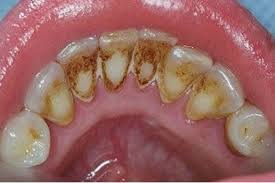 But, why are smoking teeth stains so distinctive? How Does A Smoker S Finger Or Mustache Get Yellowish By Nicotine Biology Stack Exchange