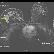 It may cause your breast to enlarge or swell, be tender, warm to the touch, look like an infection, or look like typical diagnosis is made through mammogram, possibly ultrasound or mri and biopsy. Inflammatory Breast Cancer Eurorad