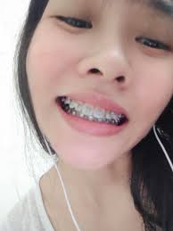 Welcome to braces photo editor! 4 Months Progress No Longer Wearing Spring Braces