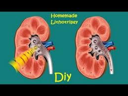 Homemade Ultrasound Lithotripsy Device For Kidney Stones Kidney Stones Remedy Kidney Stones Kidney Infection