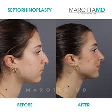 Before and After Septorhinoplasty Transformation 👏 Double the beauty,  double the transformation! These twin sisters underwent a septorhinoplasty  procedure with me at Marotta Plastic Surgery. It was important for them to  remain