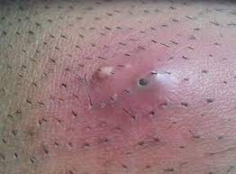 By definition, hair follicles are. Ingrown Hair Or Herpes What Is The Difference