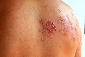 Image result for shingles