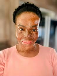 Burn Survivors South Africa NPC