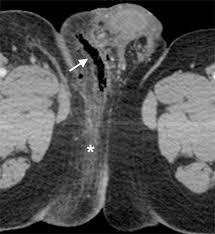 Wash your hands and don ppe if appropriate. Fournier Gangrene Pictorial Review Springerlink