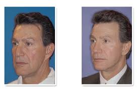 Dr T. William Evans DDS MD Columbus Cosmetic Surgeon