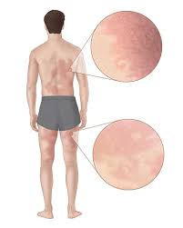We did not find results for: Alpha Gal Allergy Ticks Cdc