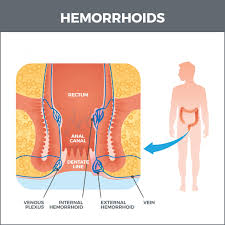Image result for hemoroid human