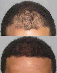 The details of african hair replacement (both the limitations and the benefits in your particular situation), and african hair transplant cost will be explained to you during your consultation with dr. Afro Hair Transplants All You Need To Know Qunomedical
