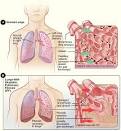 Fibrose idiopathique