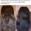 In fact, these acids and enzymes in acv can kill bacteria, which can cause many scalp and hair conditions such as dandruff, itchy scalp from eczema, hair loss and even baldness. 1
