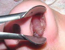 Symptoms include trouble breathing through the nose, loss of smell, decreased taste. Nasal Polyps Ear Nose And Throat Disorders Msd Manual Consumer Version