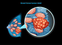 However, your symptoms may vary depending on your specific type of breast cancer. Breast Cancer Signs Symptoms Stages Treatment About Risk Factors Ashray